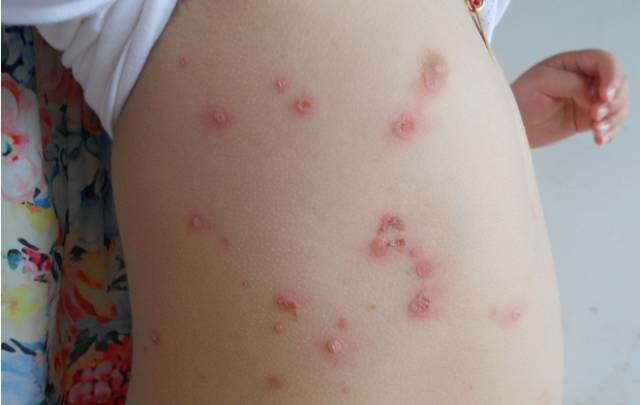 在婴幼儿及儿童当中多见,如平时不注意防护,很易因感染而导致水痘发生